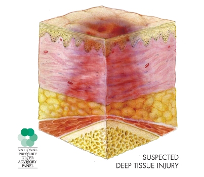 Suspected deep tissue injury