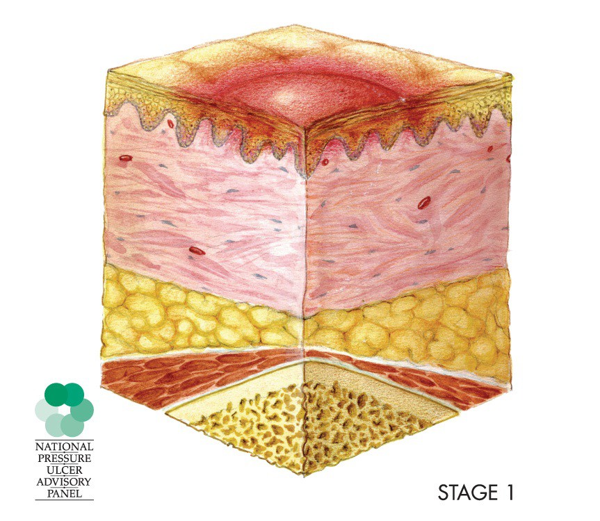 Stage 1 pressure injury