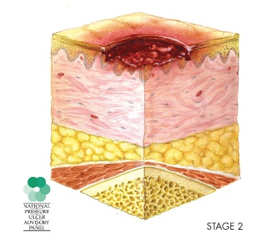 Stage 2 pressure injury