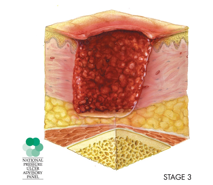 Stage 3 pressure injury