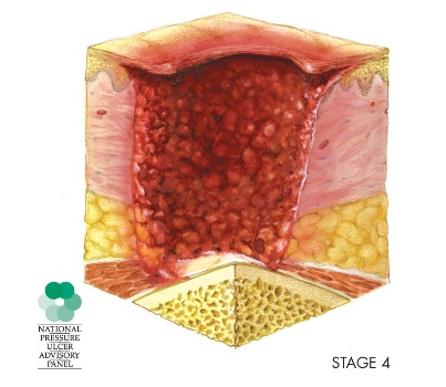 Stage 4 pressure injury