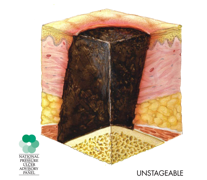 Unstageable pressure injury